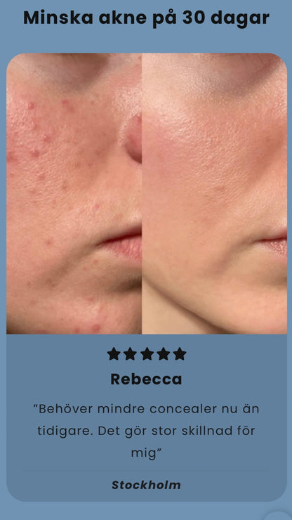 SENAX Acne Spot Treatment